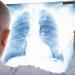 Descubren el mecanismo principal del cáncer de pulmón para evadir el ataque inmunitario