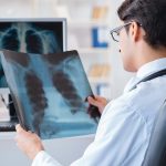 eMPACT: la inmunoterapia en cáncer de pulmón no microcítico puede ahorrar más de 6 millones al SNS