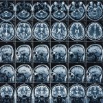 Un nuevo procedimiento para la detección precoz para el diagnóstico en Alzheimer