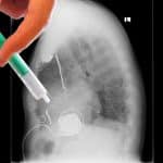 Un estudio del CNIC cuestiona el uso de fármacos betabloqueantes en infartos no complicados