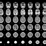 Investigadores del CNIO auguran avances clave en metástasis cerebral en la próxima década