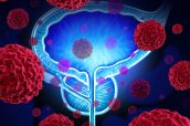 Prostate cancer danger medical concept as cancerous cells in a male body attacking the reproductive system as a symbol of human malignant tumor growth diagnosis treatment and risks.