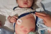 Meningitis - bebe - niño